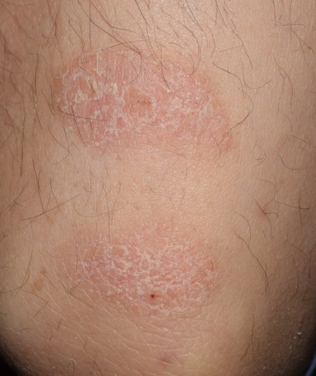 20190324 - psoriasi gomito 2.jpg