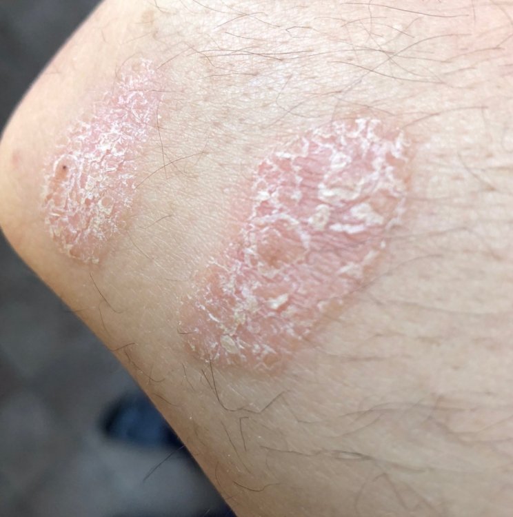 20190324 - psoriasi gomito 3.jpeg