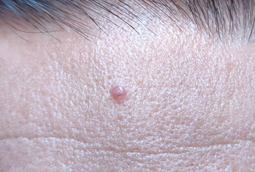 acne.jpg