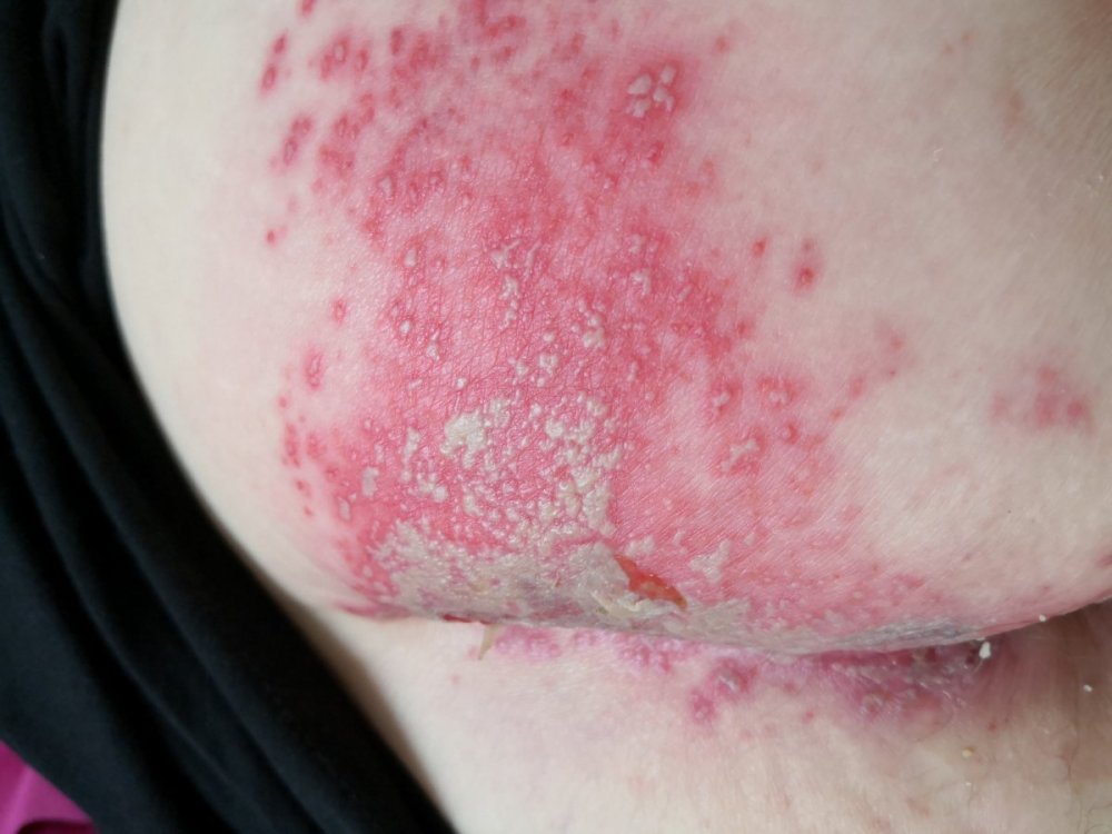 Herpes Simplex.jpg