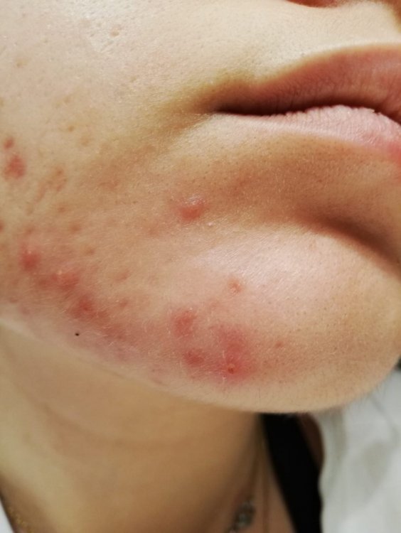 acne 3.jpeg
