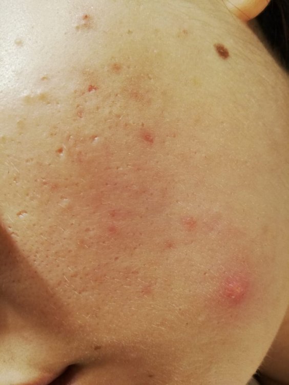 acne 1.jpeg