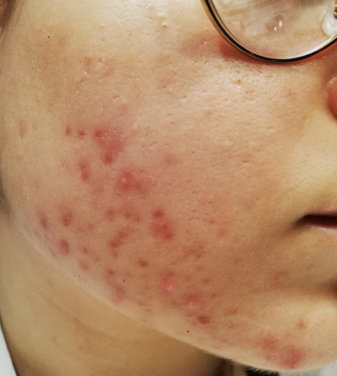 acne 2.jpeg