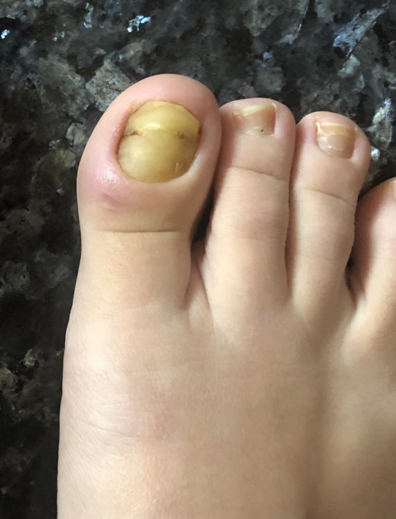 Paronichia+Micosi Alluce dx - Problemi delle unghie - DermaClub Forum