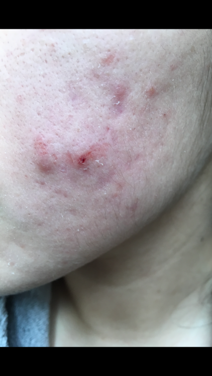 acne 1.PNG