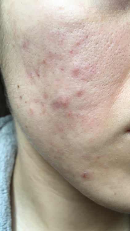 acne 2.PNG