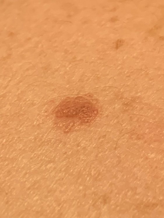NEO DI UNNA O CHERATOSI SEBORROICA? - Nei, Melanoma, Tumori cutanei