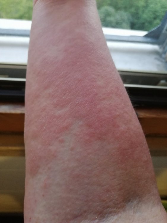 1 giugno avambraccio dx parte interna ore serali.jpg