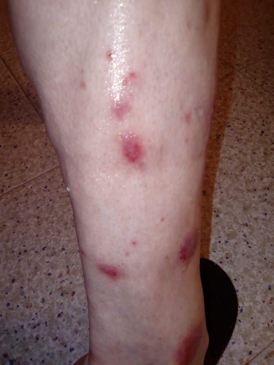 dermatite - Dermatite atopica - DermaClub Forum