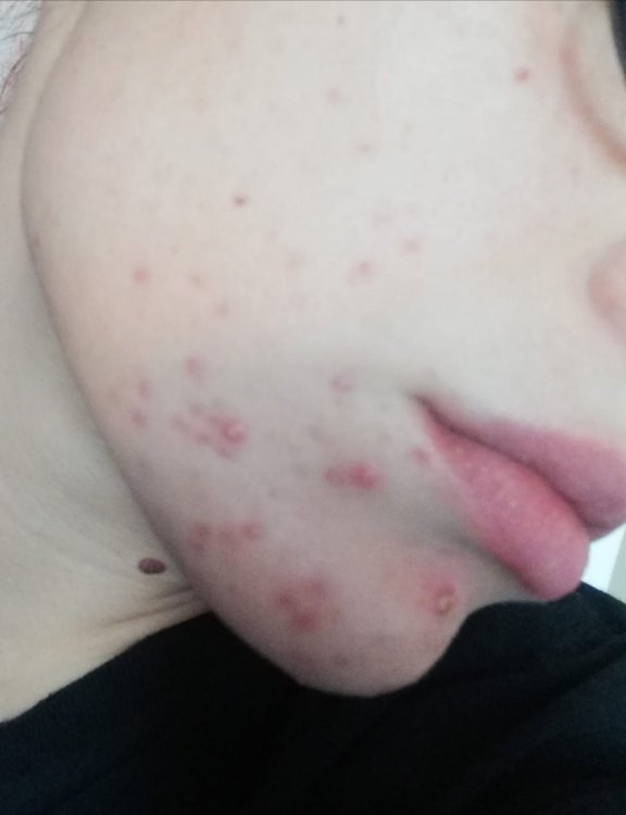 Acne 1.jpeg