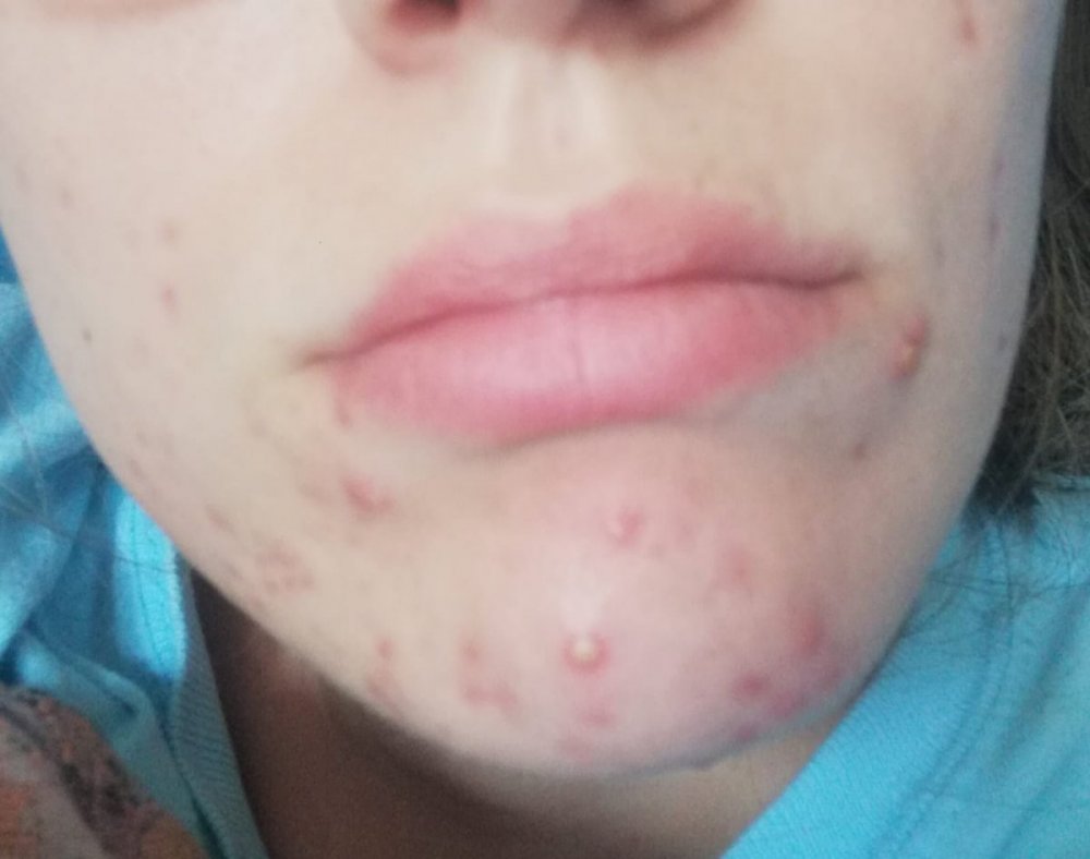 Acne 2.jpeg