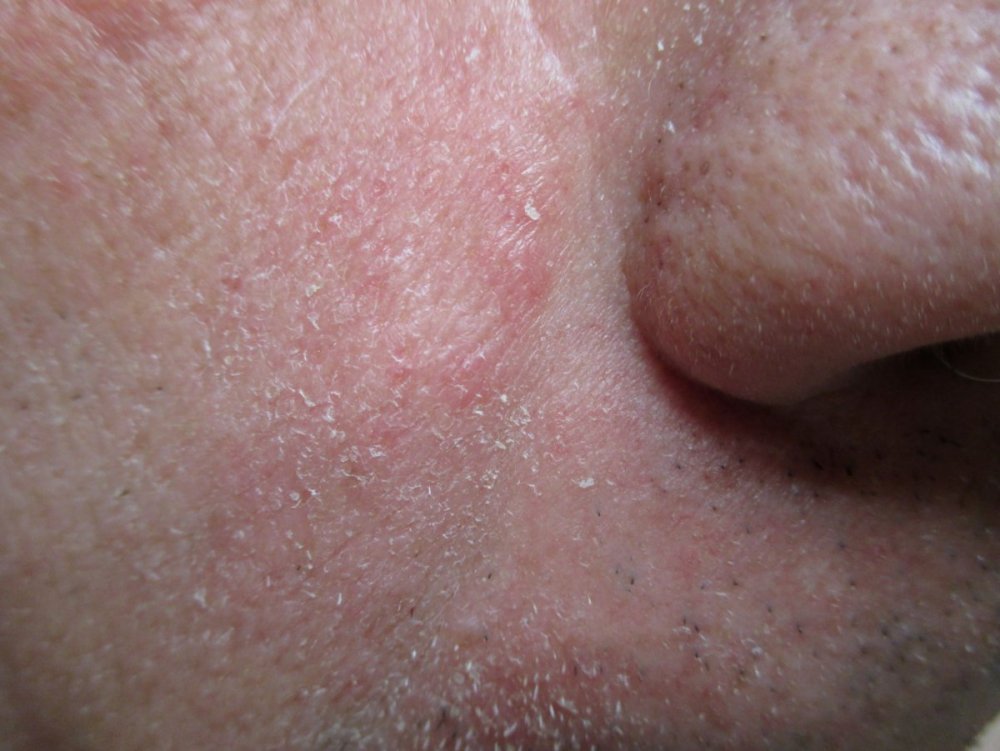 lato naso dx (2) 4 mp.JPG