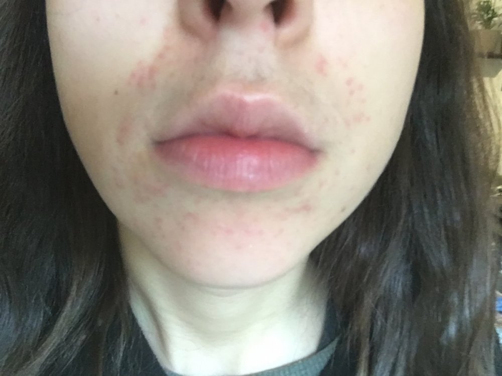 derm1f.JPG