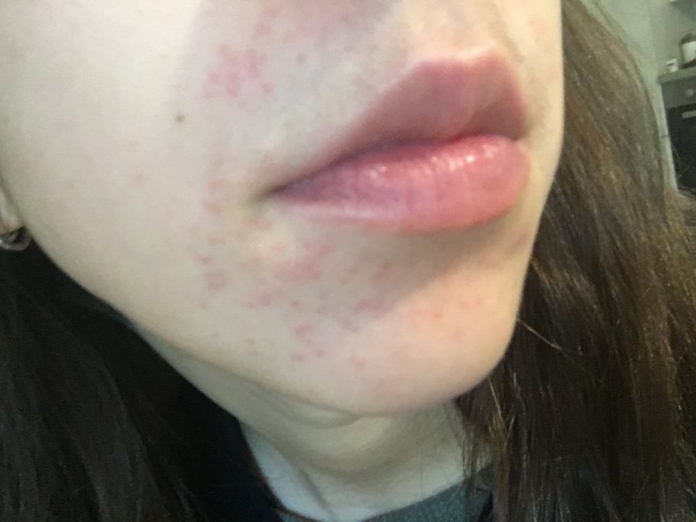 derma.1fJPG.JPG