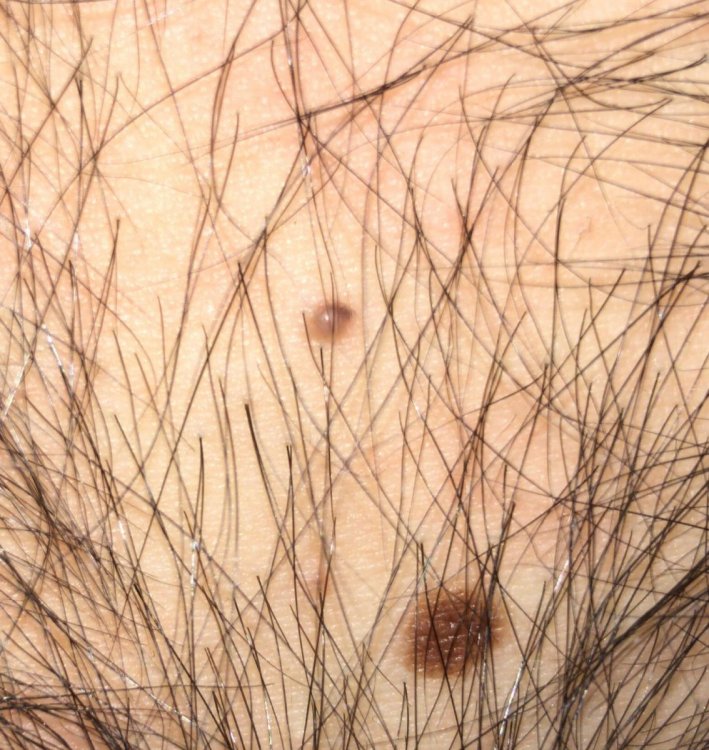 dermatofibroma.jpeg