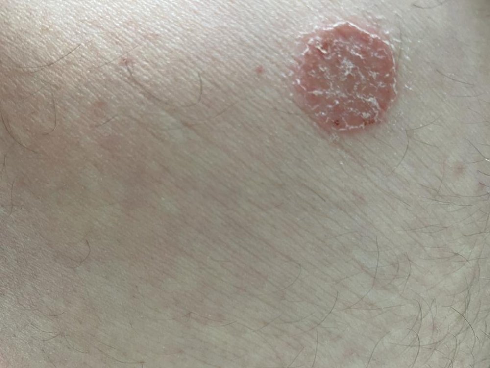 eczema1.jpeg