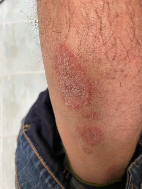 eczema3.jpeg