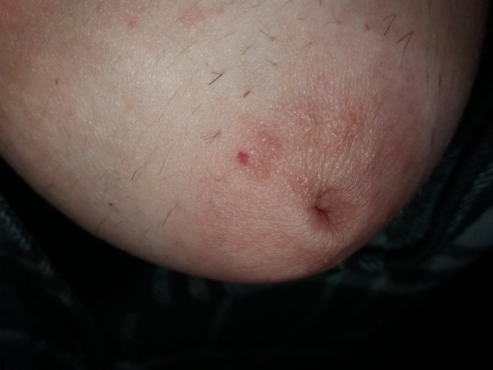 FOTO MACCHIA ROSSA SENO SX.jpg