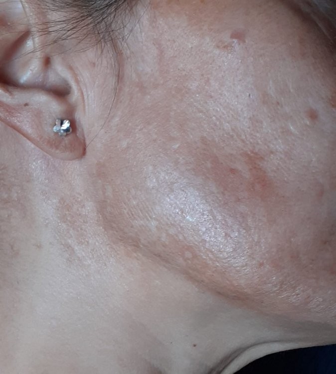 melasma.jpeg