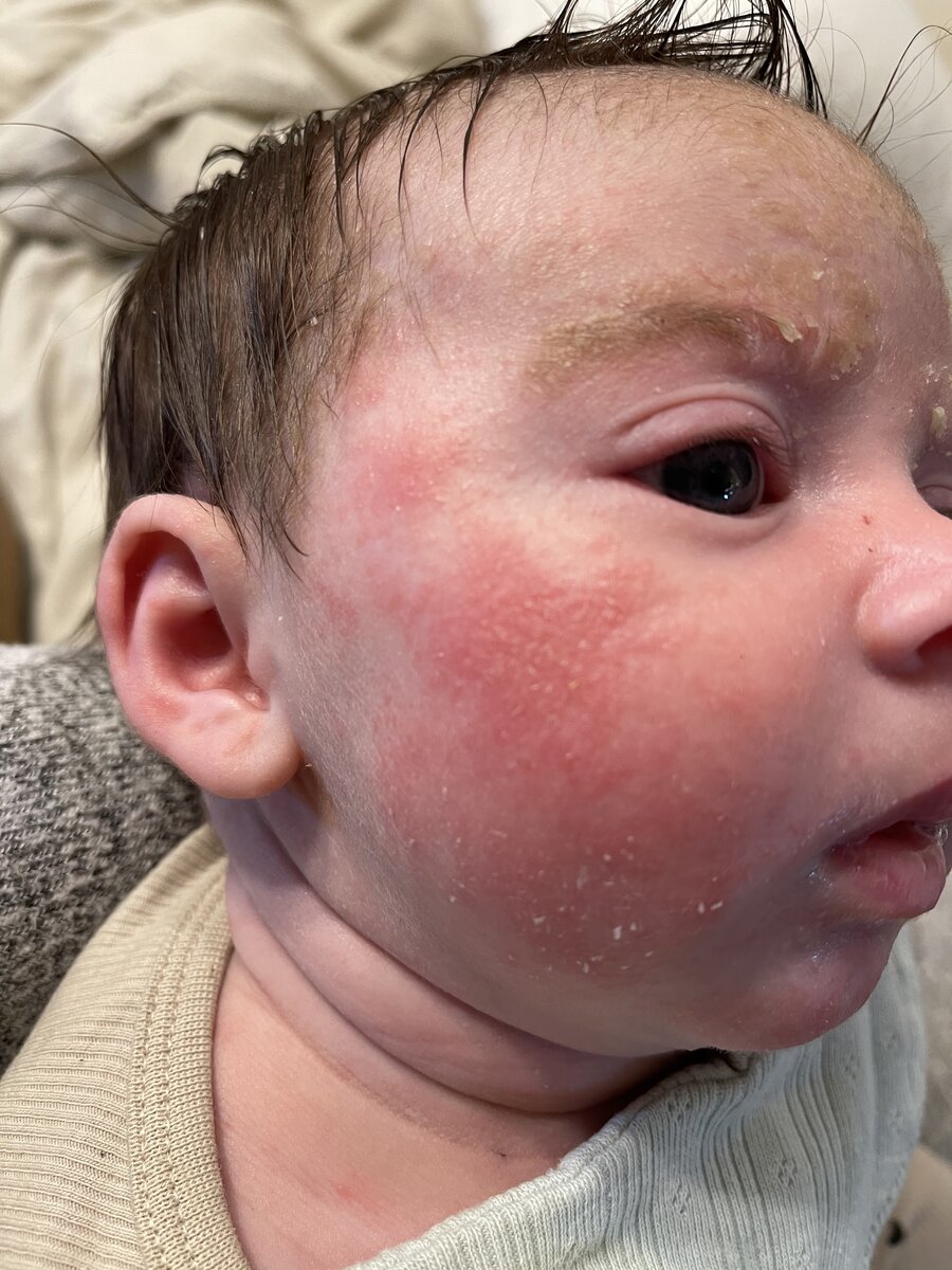 Neonata di 2 mesi con dermatite seborroica - Dermatite seborroica