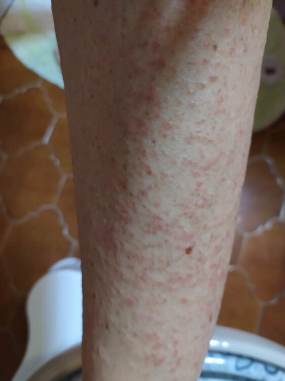 dermatite gamba.jpeg