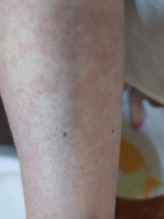 dermatite braccio.jpeg