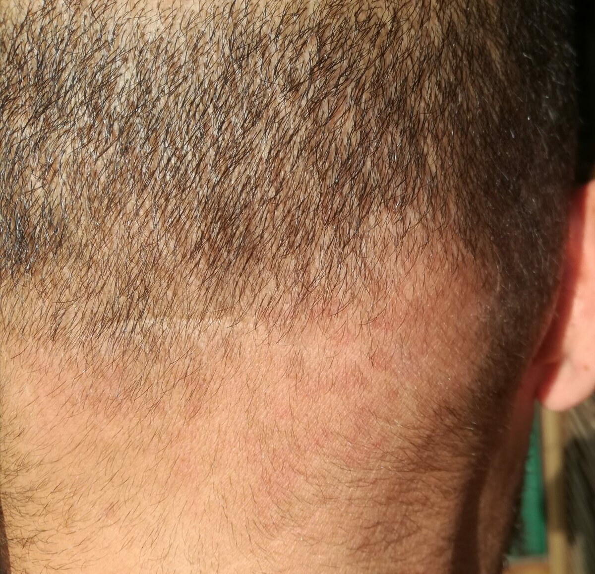 Dermatite Psoriasi O Tinea Al Cuoio Capelluto Dermatite Atopica