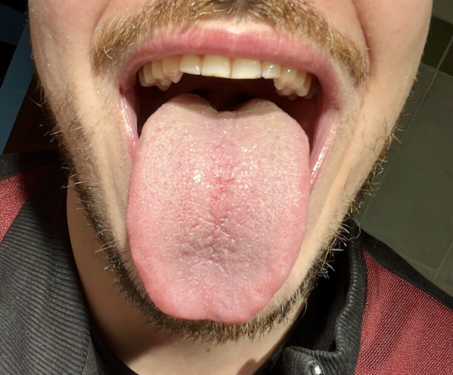 dopo_mycostatin.thumb.jpg.589cafbea261891188a6fd1d8dd09715.jpg