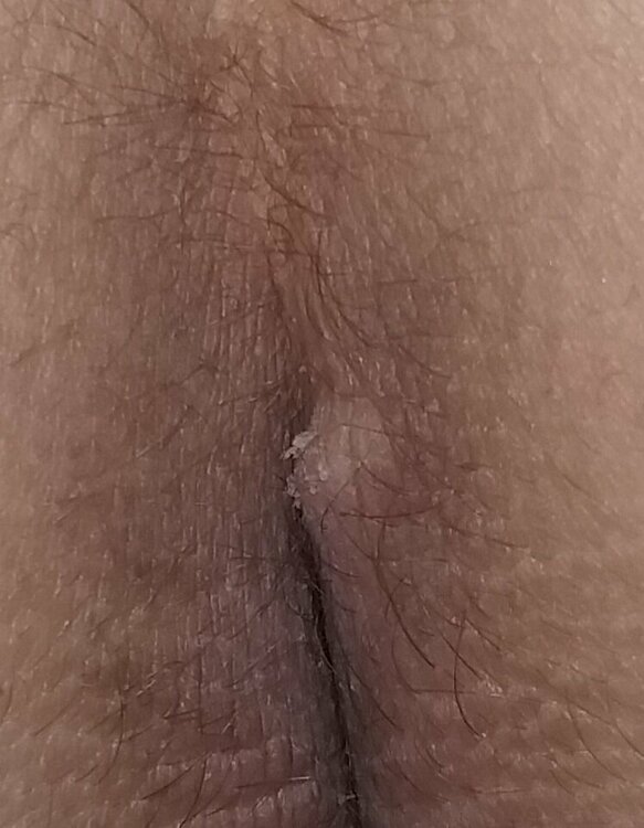 acantoma.jpg