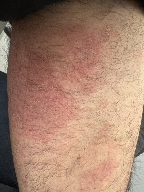 Eczema.jpg
