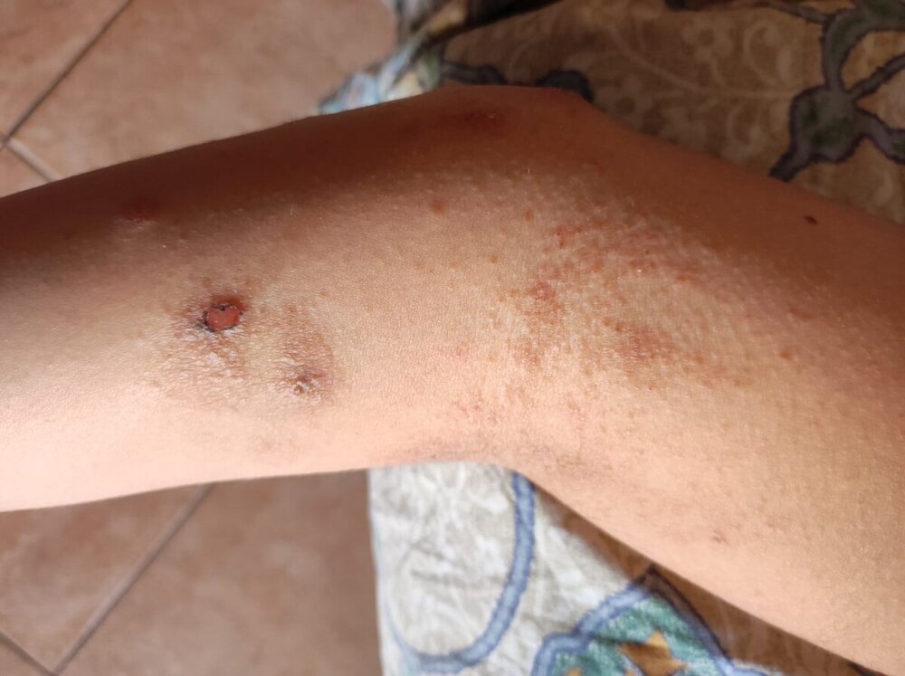 Braccio_Dermatite.jpeg