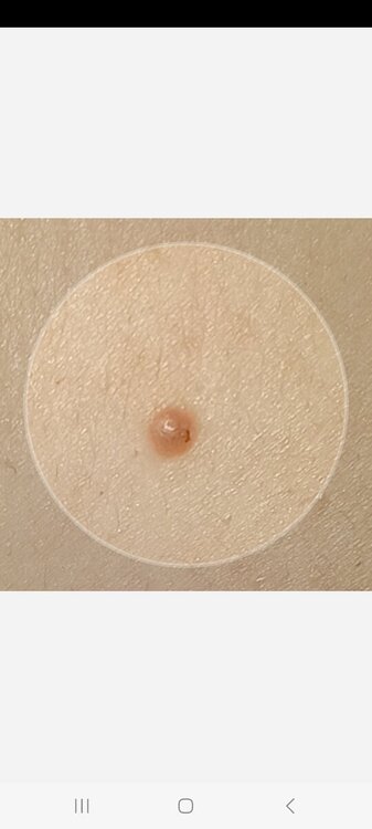 Screenshot_20240611_092913_SkinVision.jpg