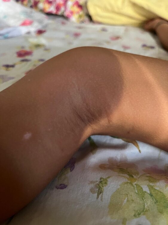 MACCHIE DIETRO GINOCCHIA.jpeg