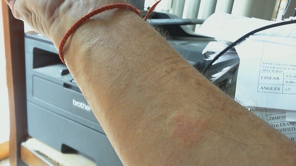 Avanbraccio dx.jpg